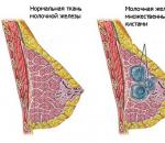 Что такое железисто-фиброзная мастопатия молочных желез
