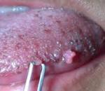 Комплексное лечение папилломы во рту
